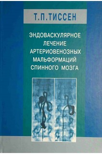 Эндоваскулярное лечение артериовенозных мальформаций спинного мозга. Тиссен Т.П.