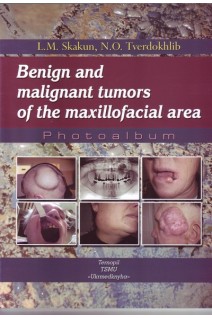 Benign and malignant tumors of the maxillofacial area (Доброякісні та злоякісні пухлини щелепно-лицевої ділянки (фотоальбом)). Skakun LM. (Скакун Л.М.)
