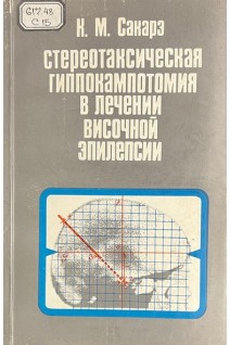 Стереотаксическая гиппокампотомия в лечении височной эпилепсии (БУ). Сакарэ К.М.